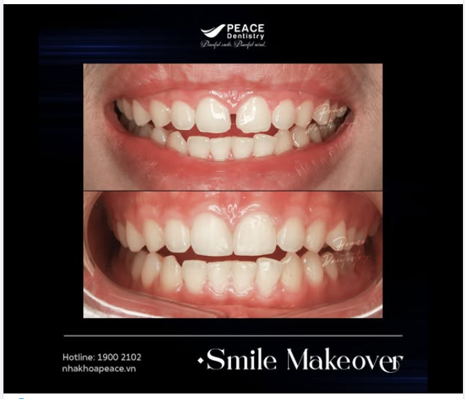 VENEER - PHƯƠNG PHÁP TRÁM KẼ RĂNG THƯA HOÀN HẢO
