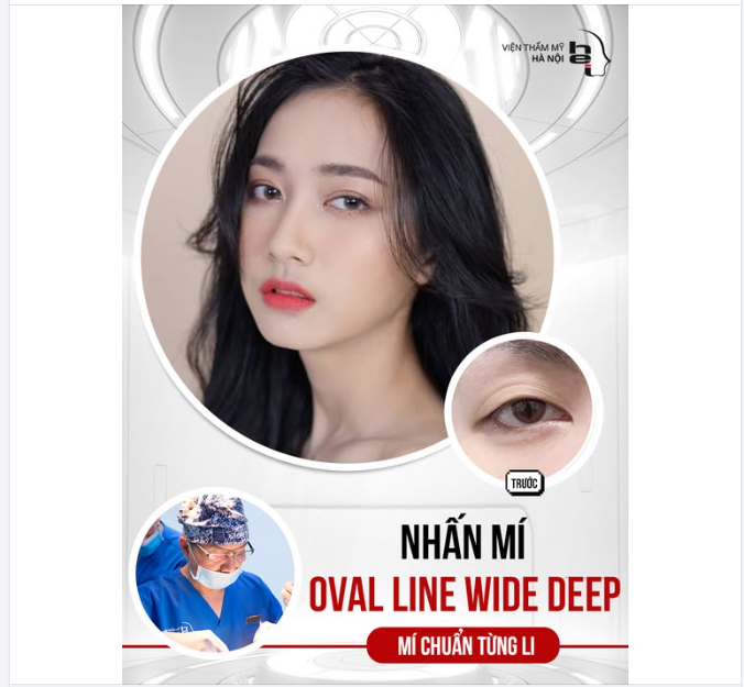 NHẤN MÍ OVAL LINE WIDE DEEP – MÍ ĐẸP CHUẨN TỪNG LI