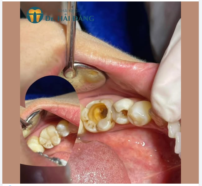 Sâu răng nặng – Đừng để đến khi đau mới đi chữa!