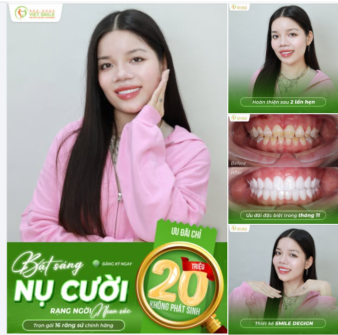 BẬT SÁNG NỤ CƯỜI – RẠNG NGỜI NHAN SẮC  CHỈ 20 TRIỆU – TRỌN GÓI 16 RĂNG SỨ CAO CẤP CHÍNH HÃNG