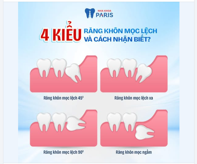 4 KIỂU RĂNG KHÔN MỌC LỆCH  CÁCH NHẬN BIẾT?