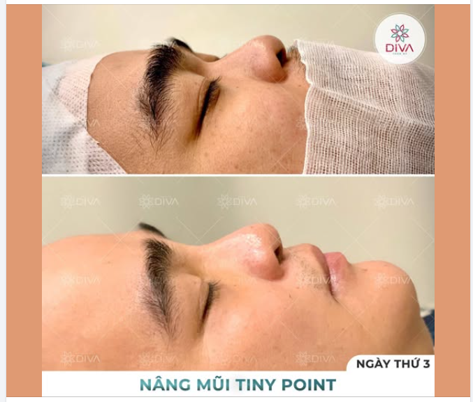 GIẢI PHÁP CẢI THIỆN TÌNH TRẠNG MŨI BỊ GÃY TRŨNG SÂU NGANG VÙNG MẮT NHƯ THẾ NÀO?