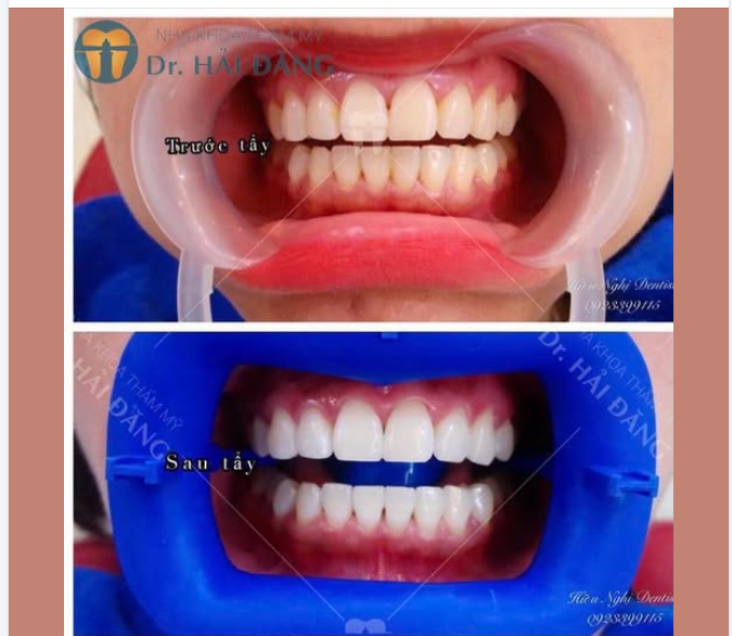 Tẩy trắng răng – Lột xác nụ cười ngay sau 1 buổi tại Nha khoa Hải Đăng