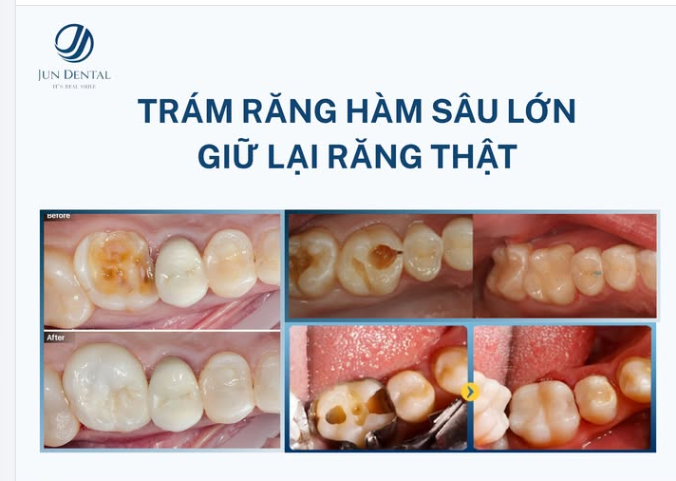 TRÁM RĂNG HÀM SÂU LỚN – GIỮ LẠI RĂNG THẬT, BẢO TỒN CHỨC NĂNG ĂN NHAI
