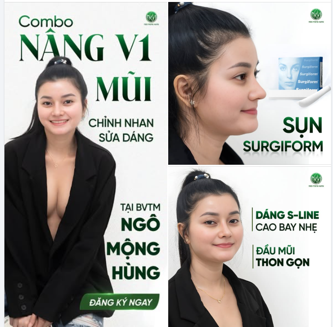 Combo nâng V1 + mũi tại BVTM Ngô Mộng Hùng