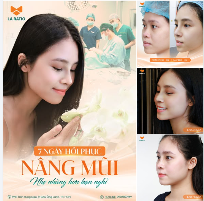 NÂNG MŨI 7 NGÀY – HỒI PHỤC ÊM DỊU TẠI LA RATIO