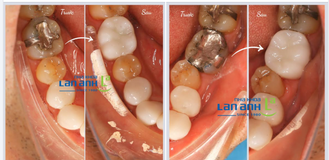 Hồi xưa nhiều người vẫn thường trám răng bằng vật liệu Amalgam, nhưng ít người biết trong Amalgam có thuỷ ngân (mercury) đó ạ.