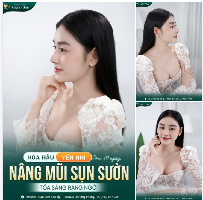 HẬU YẾN NHI – MÀN TÁI XUẤT GÂY BÃO SAU 10 NGÀY HOÀN THIỆN DÁNG MŨI MỚI