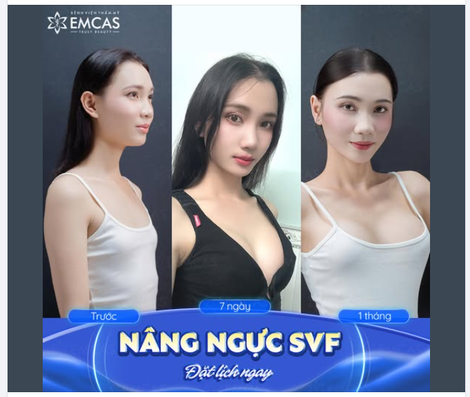Ngọc Linh, người mẫu ảnh thuộc cộng đồng LGBT, thay đổi hoàn toàn sau 1 tháng Nâng ngực SVF.