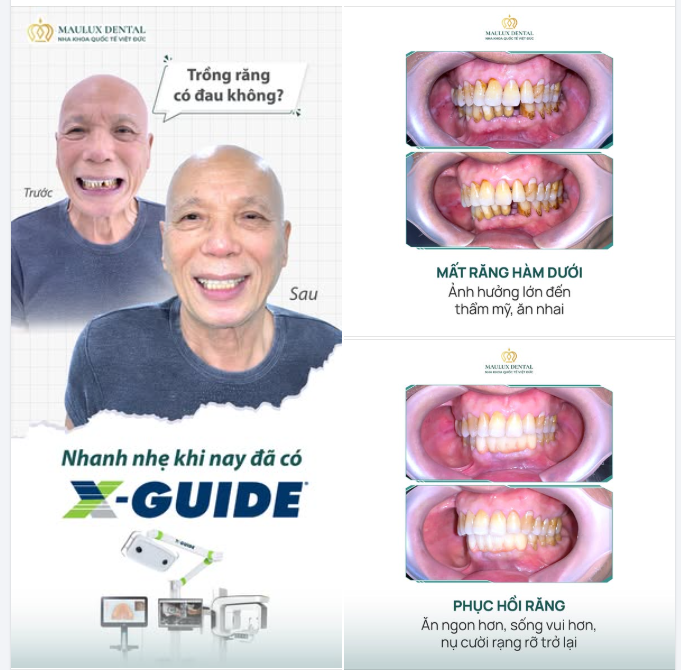 HÀNH TRÌNH LẤY LẠI NỤ CƯỜI & SỨC KHỎE RĂNG MIỆNG CỦA CHÚ LÊ TUẤN THAO