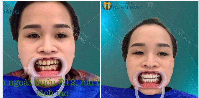 KHÁCH HÀNG THAY ĐỔI NỤ CƯỜI VỚI 20 RĂNG SỨ THẨM MỸ