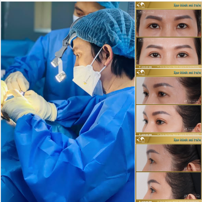 Sau 7 năm kể từ lần nhấn mí đầu tiên, chị Khách thân quen đã quay trở lại Thế Giới Đẹp – không chỉ vì kết quả cũ vẫn còn ổn định, mà vì sự tin tưởng vẫn vẹn nguyên.