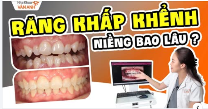 Niềng răng khấp khểnh mất bao lâu? Chỉ điểm 3 ca với 3 độ tuổi khác nhau mang lại kết quả gây "Sh.ock"