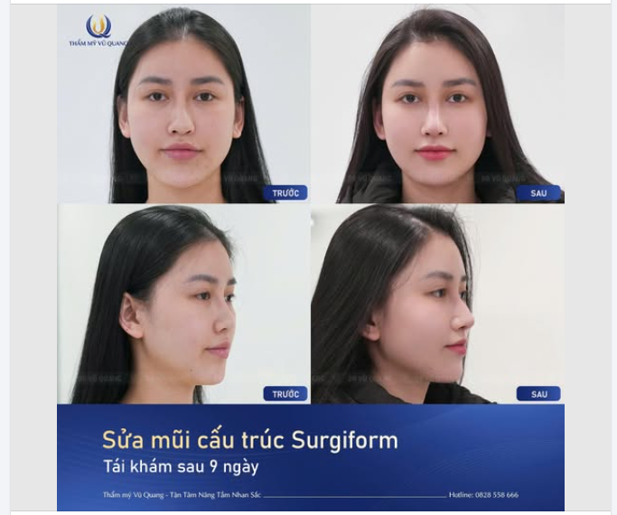 SAU 9 NGÀY, MŨI CẤU TRÚC SỤN SURGIFORM SẼ NHƯ THẾ NÀO?