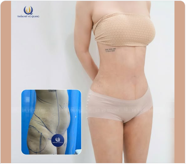 HÚT MỠ SIẾT EO - AN TOÀN TẠI BỆNH VIỆN 5 SAO