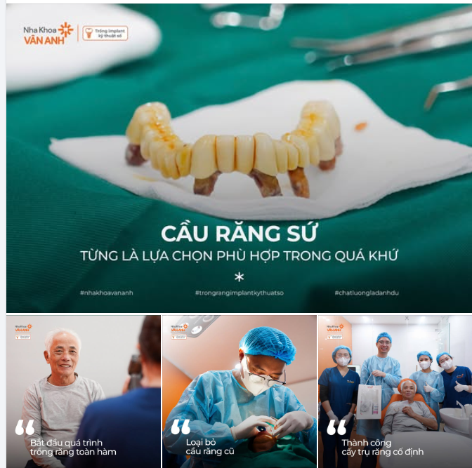 Cầu răng sứ từng là lựa chọn phù hợp trong quá khứ