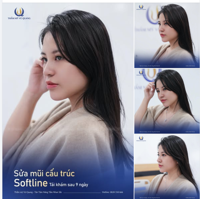 CHIÊM NGƯỠNG DÁNG MŨI SAU 9 NGÀY TẠI DR VŨ QUANG