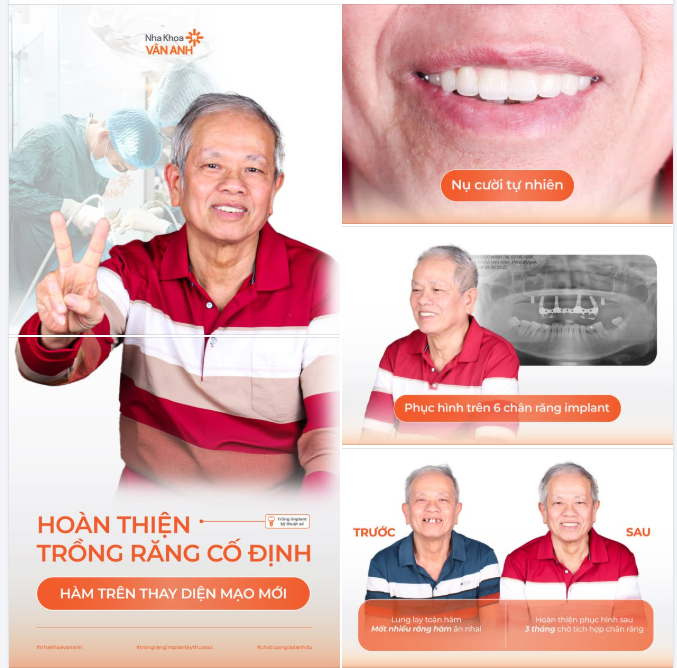 HÀM TRÊN THAY DIỆN MẠO MỚI, HOÀN THIỆN TRỒNG RĂNG CỐ ĐỊNH