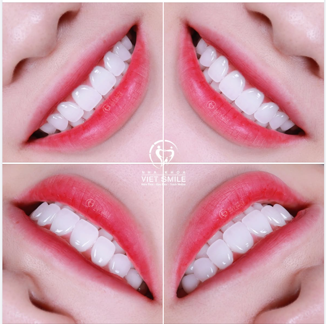 18 RĂNG SỨ EMAX ĐÁNH THỨC NỤ CƯỜI "NGỦ QUÊN"