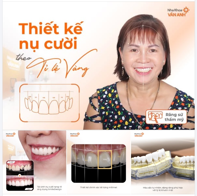 SMILE DESIGN – THIẾT KẾ NỤ CƯỜI CÁ NHÂN HÓA THEO TỶ LỆ VÀNG