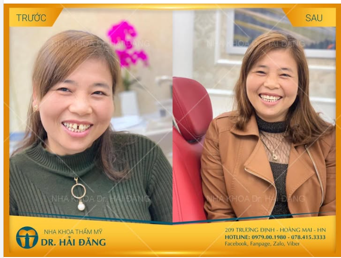 LỘT XÁC NỤ CƯỜI- THAY ĐỔI CẢ THẦN THÁI