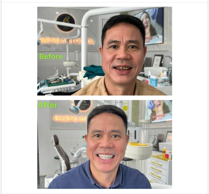 Những lưu ý sau khi làm răng sứ thẩm mỹ