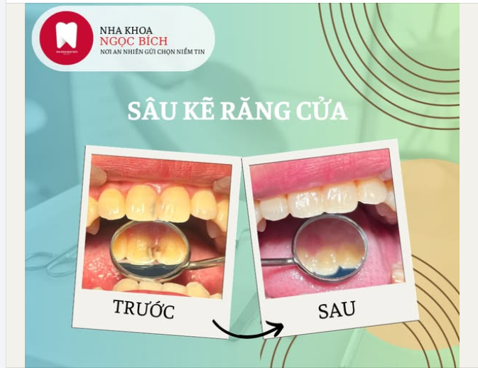 SÂU KẼ RĂNG CỬA – NHỎ NHƯNG ẢNH HƯỞNG LỚN ĐẾN NỤ CƯỜI