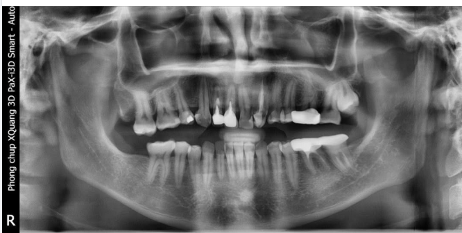 LỢI ÍCH KHI TRÁM PHÒNG NGỪA SÂU RĂNG