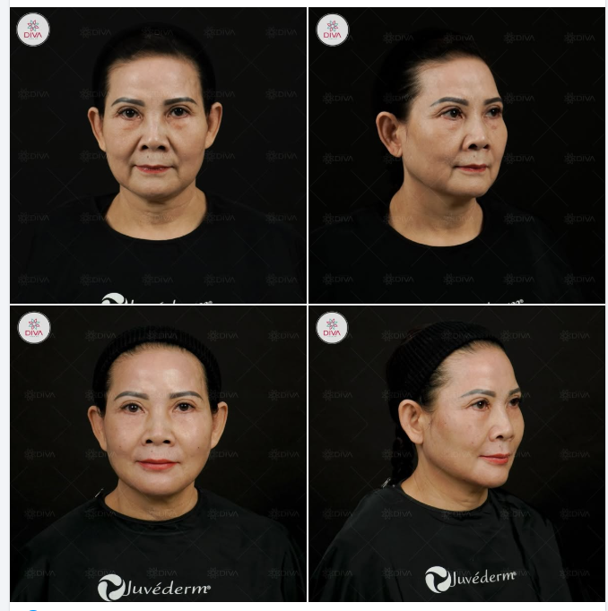 FILLER MD CODES ĐÚNG KỸ THUẬT THÌ DÙ DÙNG TỚI 16CC VẪN KHÔNG GÂY NẶNG NỀ KHUÔN MẶT