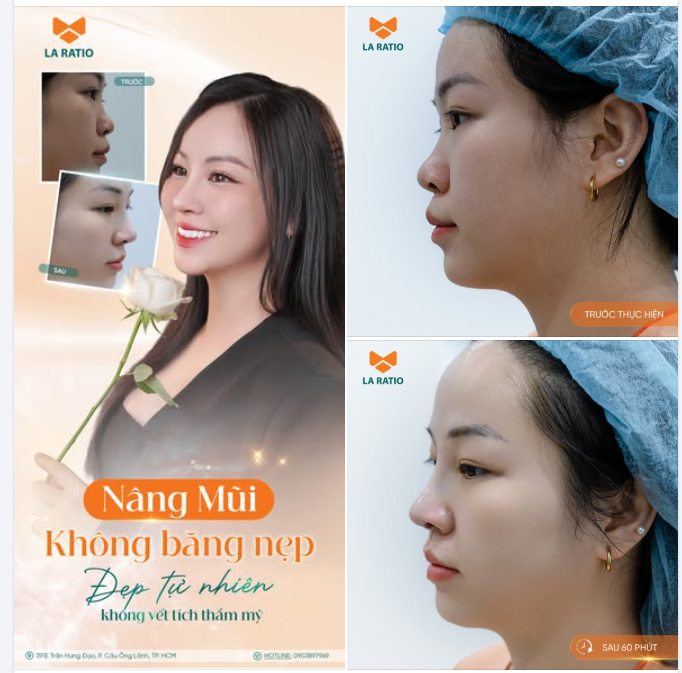 Nâng Mũi Không Băng Nẹp – Phục Hồi Nhanh Với Plasma Lạnh, Ánh Sáng Chuyên Sâu Chăm Sóc Chuẩn Y Khoa