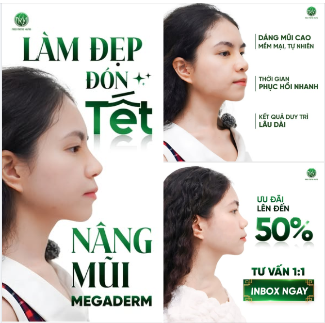 Làm đẹp đón Tết - Nâng mũi megaderm