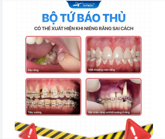 CẢNH BÁO: “BỘ TỨ PHẢN DIỆN” CÓ THỂ XUẤT HIỆN KHI NIỀNG RĂNG SAI CÁCH!