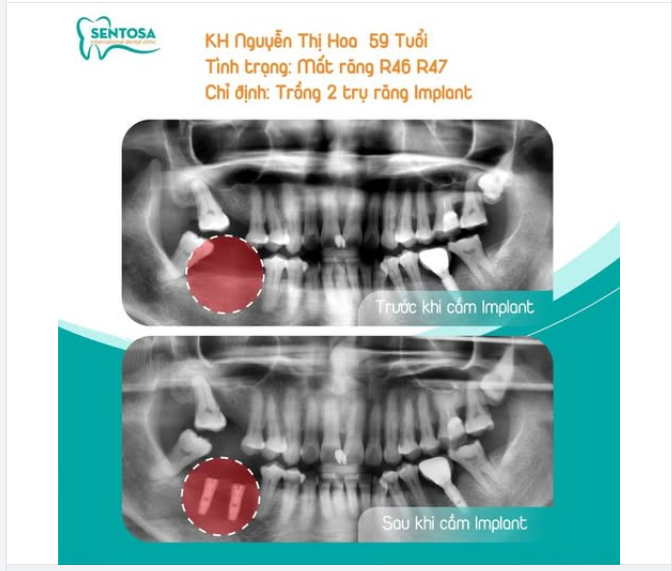 KHÔI PHỤC ĂN NHAI – KHÔI PHỤC CHẤT LƯỢNG SỐNG CHO CÔ NGUYỄN THỊ HOA