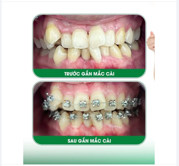 KHỞI ĐỘNG CHỈNH NHA - CẢI THIỆN KHUYẾT ĐIỂM NỤ CƯỜI