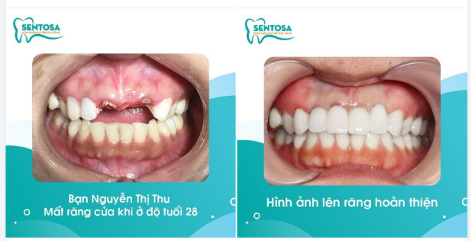 TỰ TIN TRỞ LẠI SAU TAI NẠN – HÀNH TRÌNH TRỒNG RĂNG IMPLANT CỦA BẠN THU