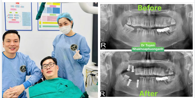 Implant – giải pháp thay thế răng mất tự nhiên và bền vững nhất hiện nay.