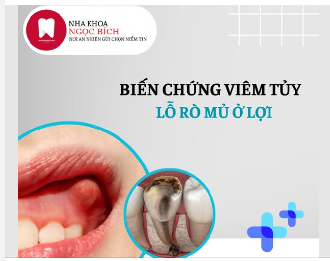 LỖ RÒ DO VIÊM TỦY – DẤU HIỆU RĂNG ĐÃ NHIỄM TRÙNG NẶNG!