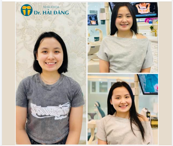 Trước và sau niềng răng thay đổi nhỏ khác biệt lớn