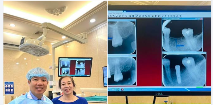 ĐÓN VIỆT KIỀU CANADA – CÔ XUÂN CẤY GHÉP 2 TRỤ IMPLANT HÀN QUỐC THÀNH CÔNG TỐT ĐẸP