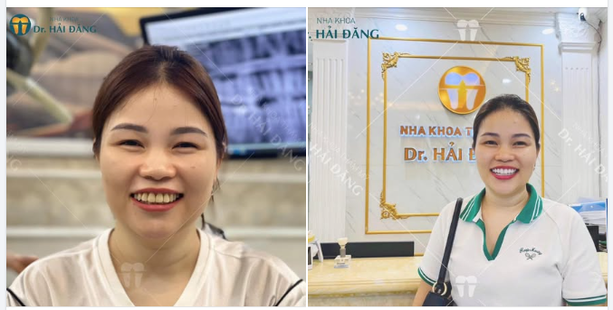 Bọc răng sứ thẩm mỹ đầu tư cho nụ cười vàng