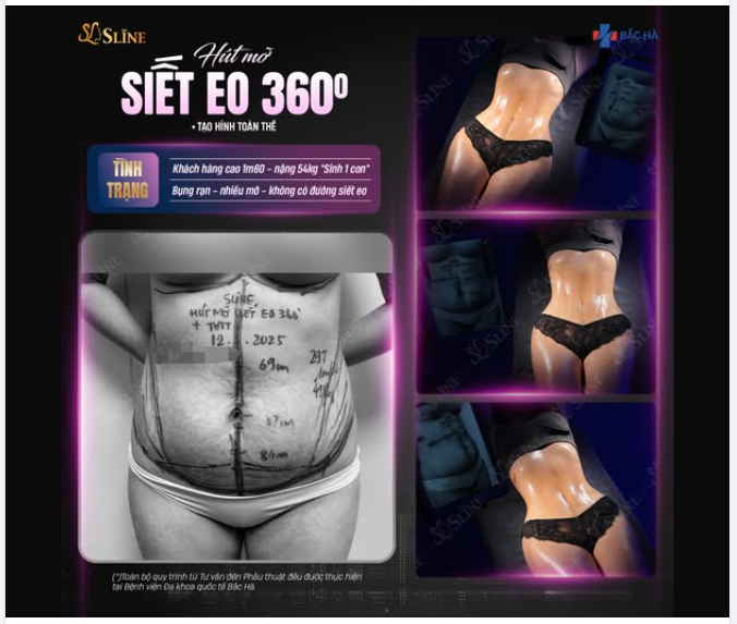 HÚT MỠ SIẾT EO 360° – TẠO HÌNH TOÀN THỂ