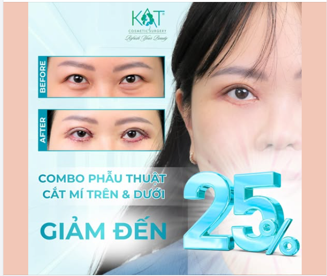 Cắt mí trên, dưới– Trẻ hóa mắt chỉ sau 1 liệu trình