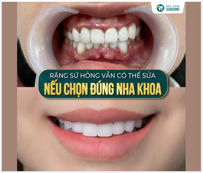 Răng sứ hỏng vẫn có thể sửa quan trọng là bạn chọn ĐÚNG nha khoa!