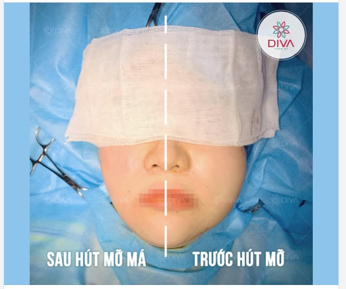 VÌ SAO SAU HẠ GÒ MÁ MẶT CÀNG PHÍNH VÀ BỊ XỆ XUỐNG?