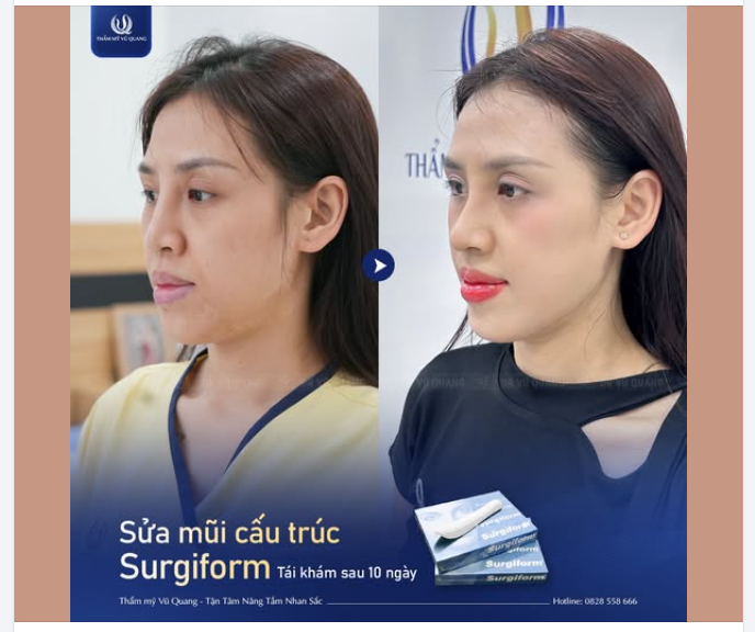 HỒI SINH "MŨI MỌC TỪ TRÁN" CHO BẠN GÁI XỨ HUẾ