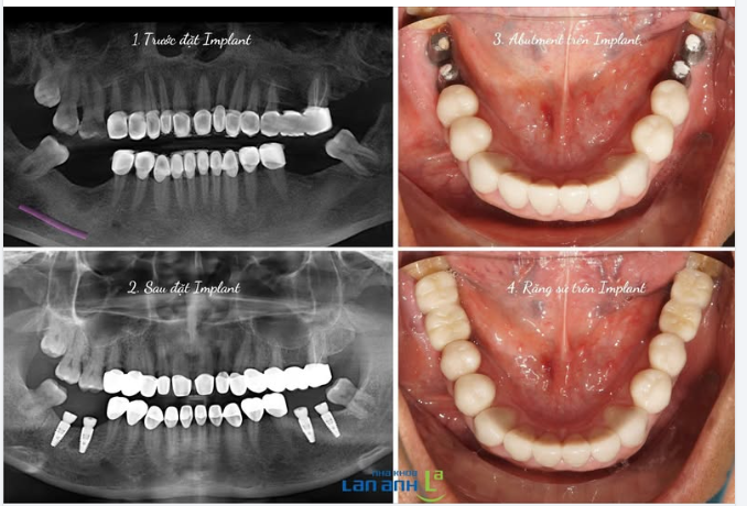 Giải pháp vững chắc cho vùng răng trong cùng – Implant kết hợp răng sứ chuẩn xác.