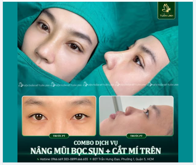 NÂNG MŨI BỌC SỤN + CẮT MÍ COMBO ĐẸP SỞ HỮU NHAN SẮC THẦN THÁI, ĐẸP CUỐN HÚT!!