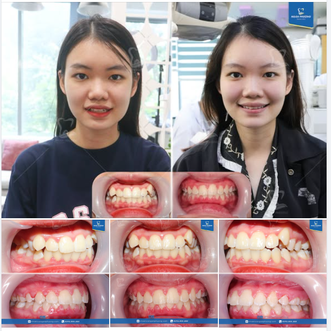 2 năm cùng Ngọc Linh chinh phục nụ cười khỏe đẹp