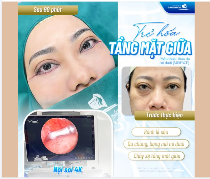 TRẺ HÓA TẦNG MẶT GIỮA - MIDFACE