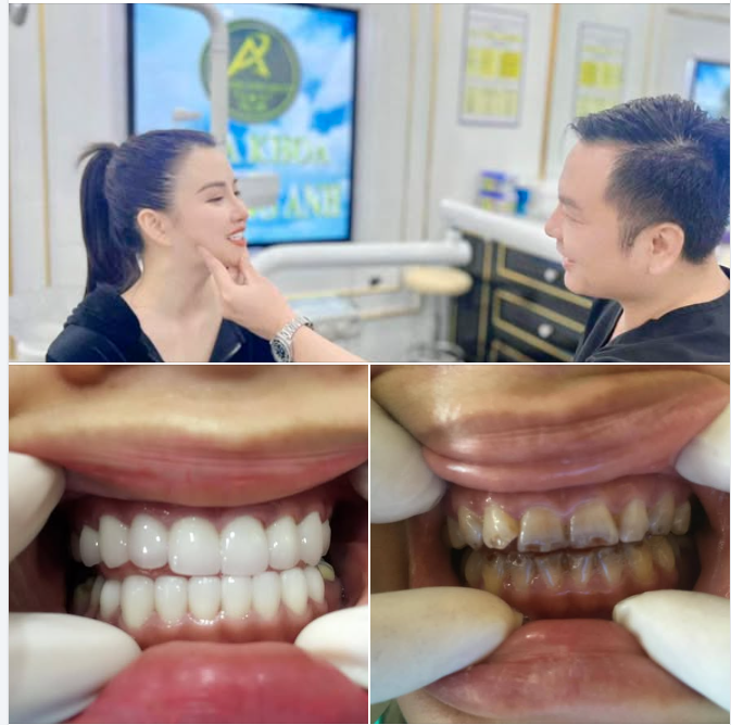 Bọc răng sứ thẩm mỹ thay đổi nụ cười